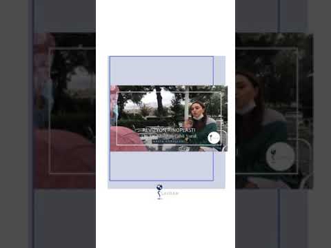 Revizyon Rinoplasti Olan Hastamız