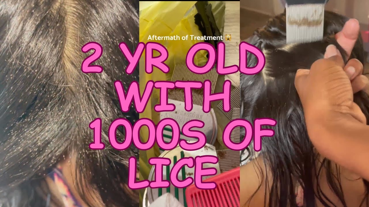 Lice Treatment on a Toddler l 1000s of Lice l Small Business YouTube