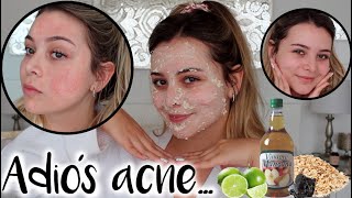 Popa Araña Ups Rutina para eliminar el acné y sus cicatrices! Remedios Naturales -  Maqui015 ♥ - YouTube