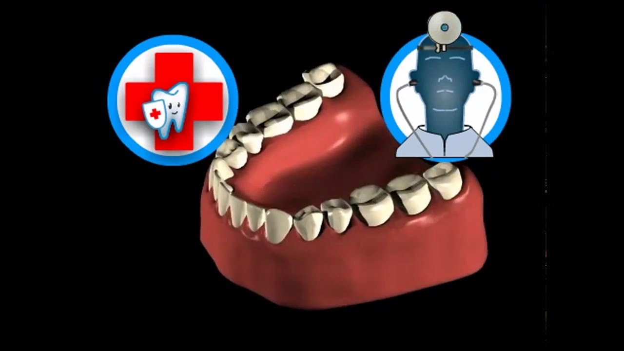 Защита от кариеса при помощи закрытия фиссур.