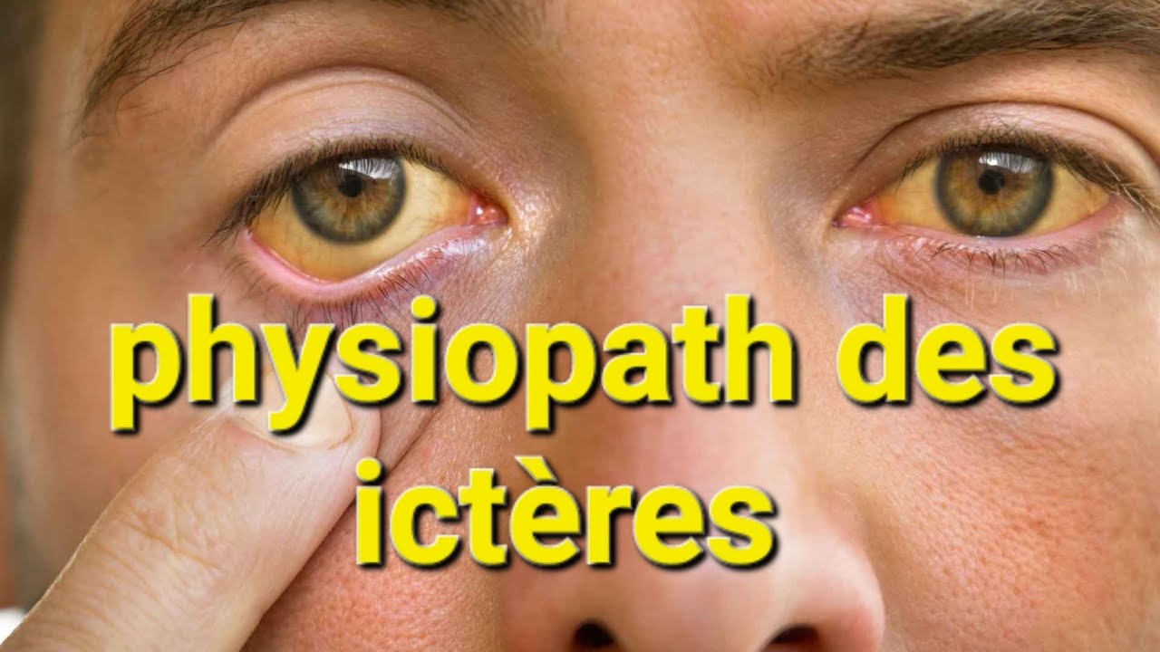 🟡 PHYSIOPATHOLOGIE DES ICTÈRES