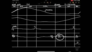 PRESSURE VOLUME CHANGES IN LEFT VENTRICLE I PV LOOP 