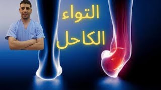 تمزق أربطة الكاحل | التواء الكاحل |التواء الكاحل المتكرر|التواء الكاحل المزمن|دكتور احمد حسن جمعه