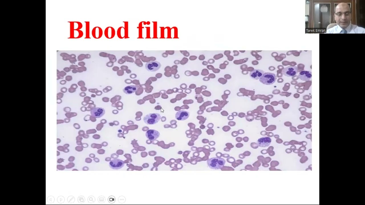 أ د طارق عمرانRed flags of WBCS Disorders