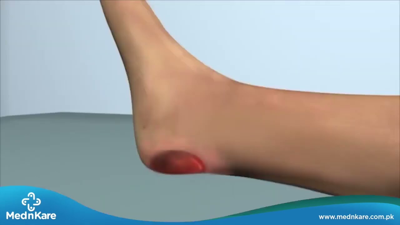 What is a Bed Sore? Bedsore kya hai? MednKare YouTube