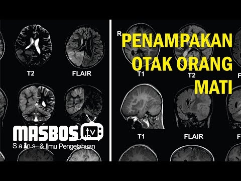 Video: Apa Yang Terjadi Pada Otak Manusia Setelah Kematian - Pandangan Alternatif