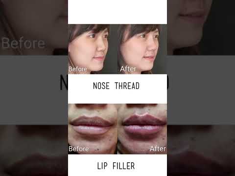 Nose Tread & Lip Filler Treatment