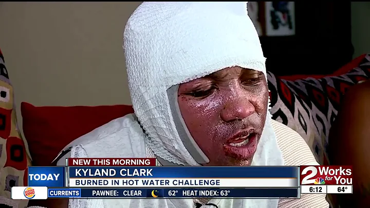 "Hot Water Challenge" sending kids to hospitals nationwide