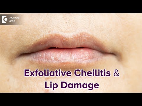 Video: 3 måter å kurere eksfolierende cheilitis på