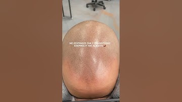 2nd session - hair tattoo #scalpmicropigmentation #smp #hairlosstreatment #scalpnation