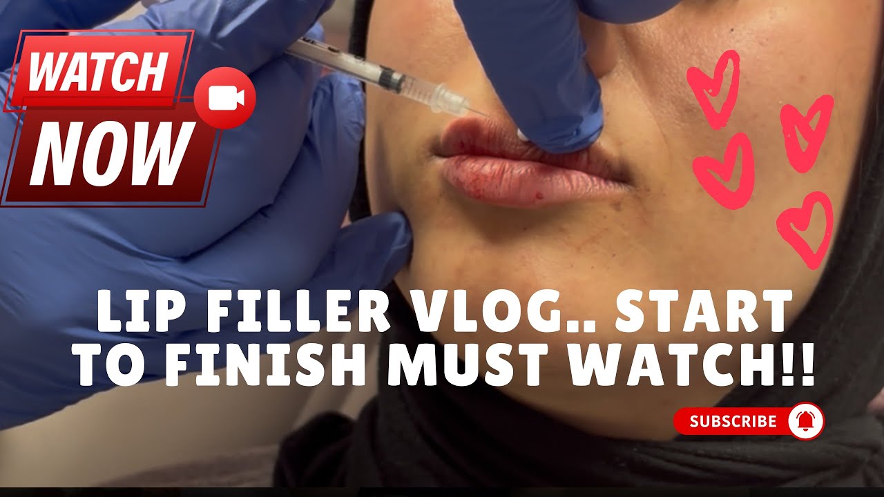 FIRST TIME LIP FILLER FROM START TO FINISH.. MUST WATCH. 💋💉😍