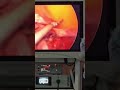 total laparoscopic hysterectomy