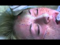 Deep FX and Active FX Laser for Acne Scars by Dr. Joe Niamtu, III