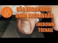 Uña encarnada - Unha encravada - Ingrown toenail [Podología Integral]