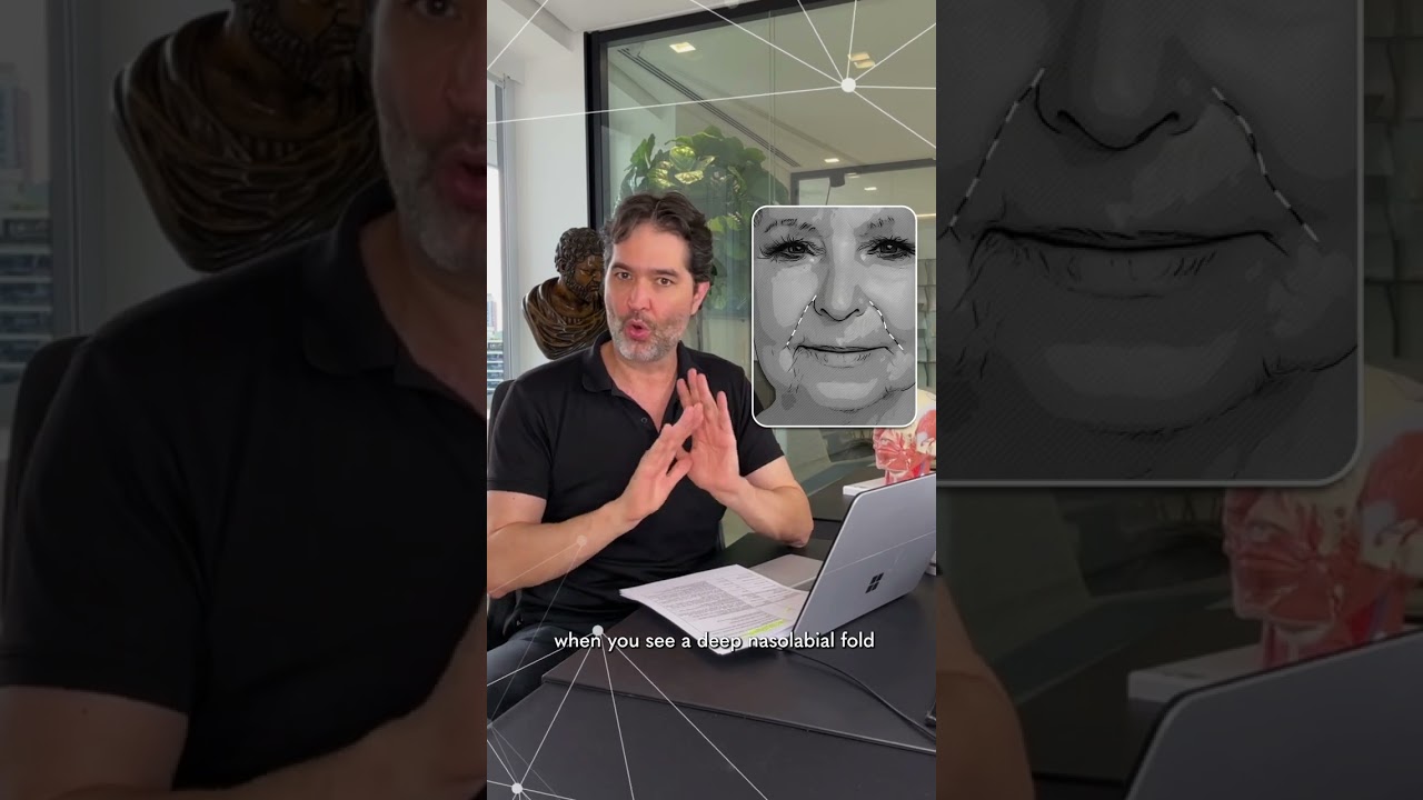 How to approach the Nasolabial folds? - MD Codes Q&A Session