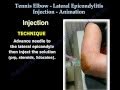 Tennis Elbow Lateral Epicondylitis Injection - Everything You Need To Know - Dr. Nabil Ebraheim