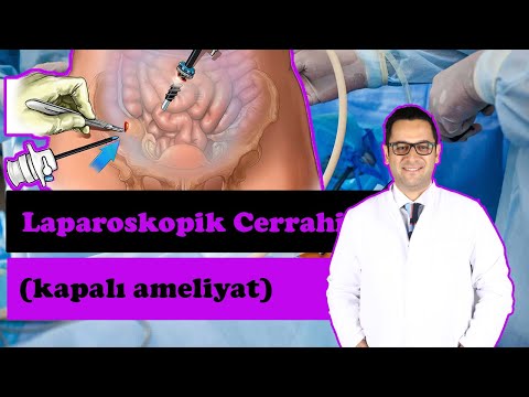 LAPAROSKOPİK (KAPALI) AMELİYAT OLACAKLAR ('Açık ameliyatlar' tarihe mi karışıyor? )