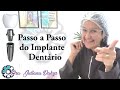 IMPLANTE DENTÁRIO PASSO A PASSO. SAIBA TUDO SOBRE!