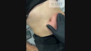 Client Spotlight: Unveiling the Why Behind Fat Freezing at Sculpt Body Clinics