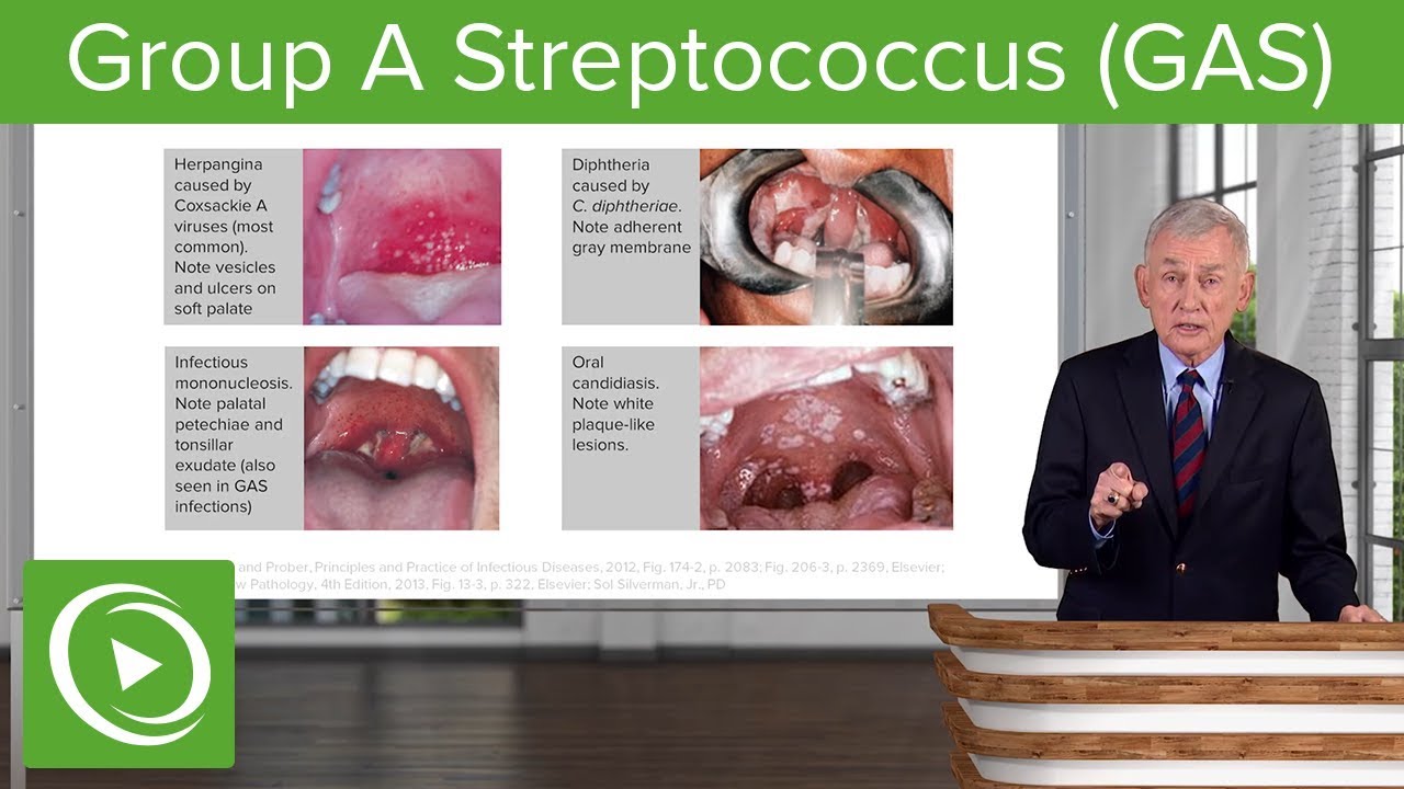 ⁣Group A Streptococcus (GAS) – Infectious Diseases | Lecturio