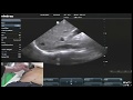 Hot Tips - IVC Volume Assessment with Ultrasound