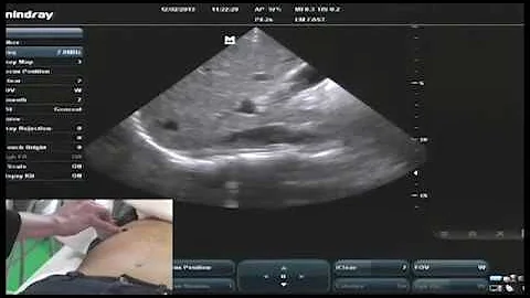 Hot Tips - IVC Volume Assessment with Ultrasound