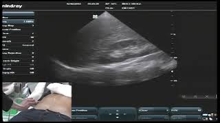 Hot Tips - IVC Volume Assessment with Ultrasound