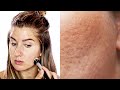 Dos and donts to applying makeup on pitted acne scars  icepick scars boxcar scars