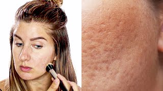 Do's And Don'ts To Applying Makeup On Pitted Acne Scars \/ Icepick Scars\/ Boxcar scars