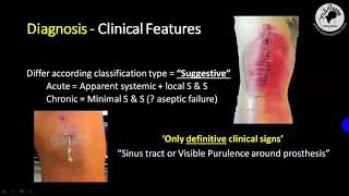 REVISION TOTAL KNEE ARTHROPLASTY and Periprosthetic Infection PJI TKA