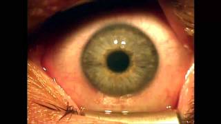 Download lagu PRK surgery surface ablation Shannon Wong MD 8 7 11 PRK surgery surface ablation Shannon Wong MD 8 7 11
