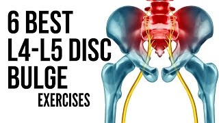 6 Best L4 L5 Disc Bulge Exercises in Hindi to avoid surgery