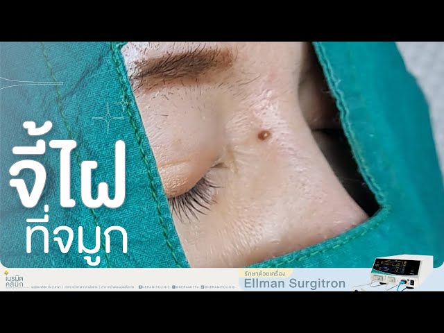 รีวิวตัดไฝ ขี้แมลงวัน EP.383/จี้ไฝที่ดั้งจะมีรอยแผลมั้ย? @หมอปุ๊ NeramitClinic