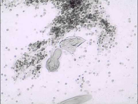 Video: Minskning Av överföring Av Schistosomiasis Mansoni I Oman