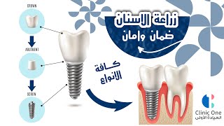 زراعة الاسنان بالعيادة الاولى في بغداد