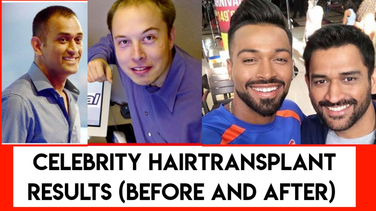 Celebrity Best Hair Transplant Results Before After Hairtransplant