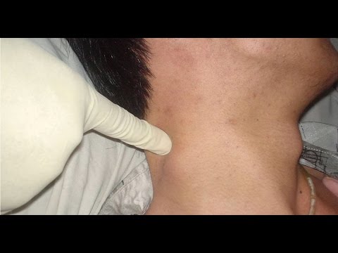 lymphoma symptoms and signs youtube