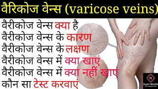 वेरीकोज वेन्स क्या है,वैरीकोज वेन्स के कारण,varicose veins ke karan,varicose veins exercise