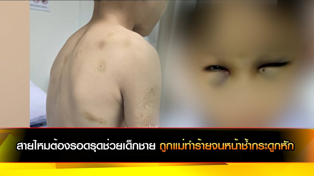 สายไหมต้องรอดรุดช่วยเด็กชายถูกแม่ทำร้ายจนหน้าช้ำกระดูกหัก