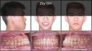Treatment of CIII Malocclusion with Insignia｜【Chris Chang Ortho】CC642