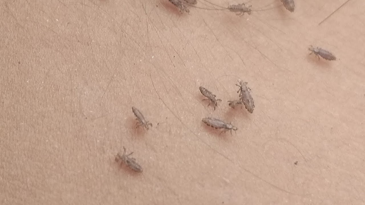 Lice removal long hair// nits removal long hair//Nits picking YouTube