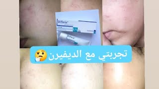 تجربتي مع مقشر #ديفيرين_كريم  Differin Cream.