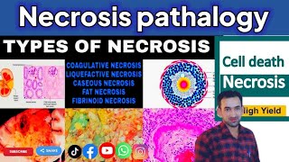 Necrosis/ Types of Necrosis/ Pathophysiology of Necrosis