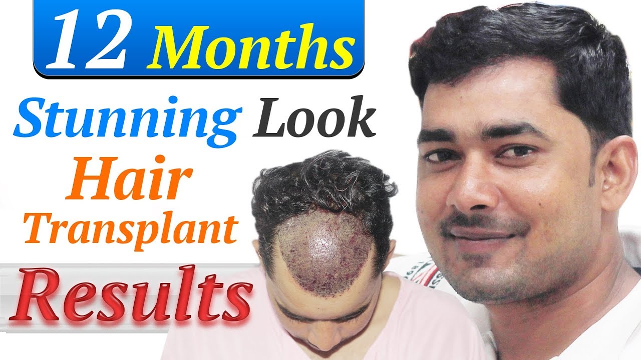 Want to know cost of hair transplantation in Delhi India by jitendra gupta   Issuu