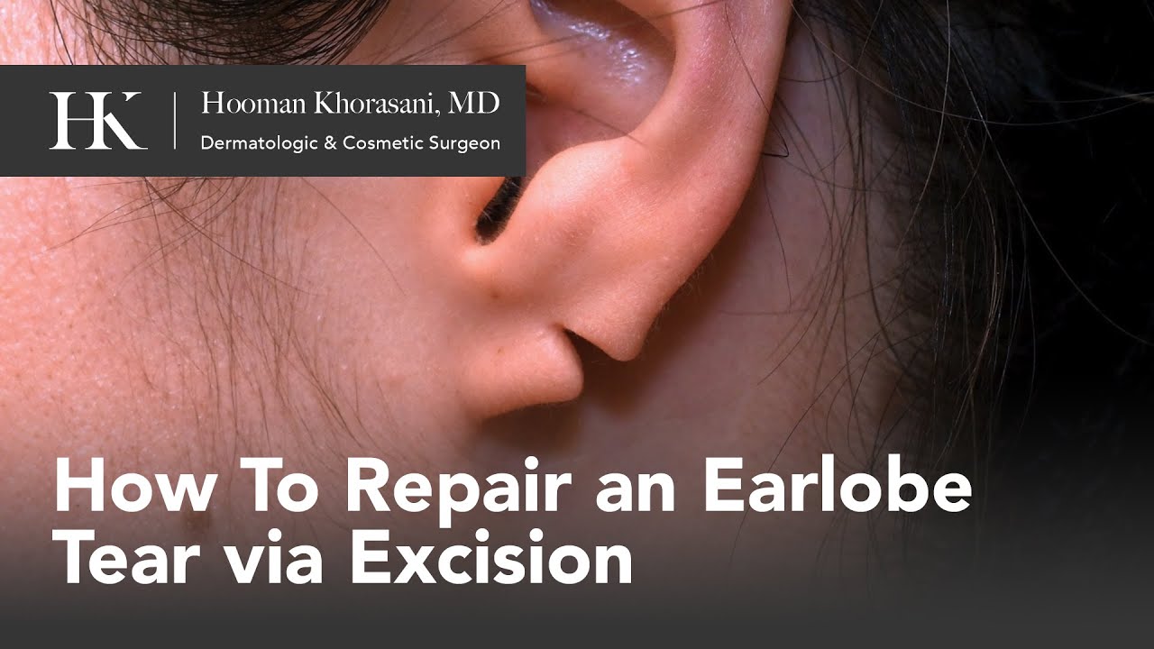 Earlobe Treatment Service at best price in Vellore | ID: 2851644323597