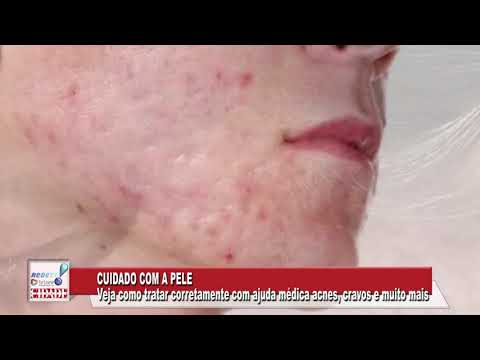 Tratamento de casos mais grave da acne (Roacutan)