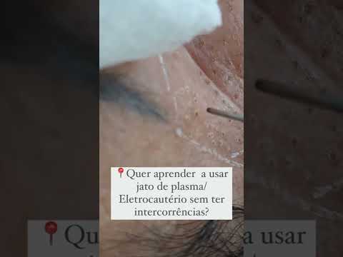 Vídeo: Fulguração é o mesmo que eletrocautério?