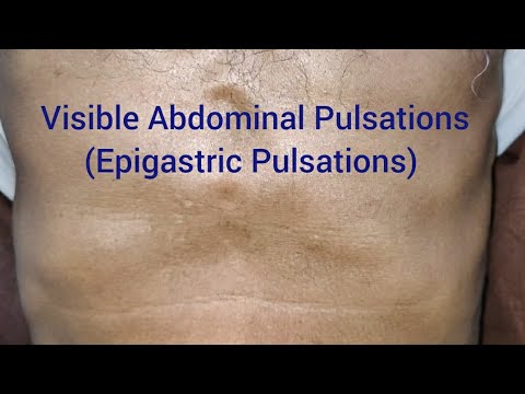 Clinical Examination: Visible Epigastric Pulsations