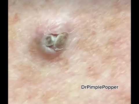 WHAT Is This On The Arm Extractions With Dr Pimple Popper Shorts Dpow 