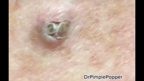 WHAT is this on the arm? Extractions with Dr. Pimple Popper #shorts #dpow